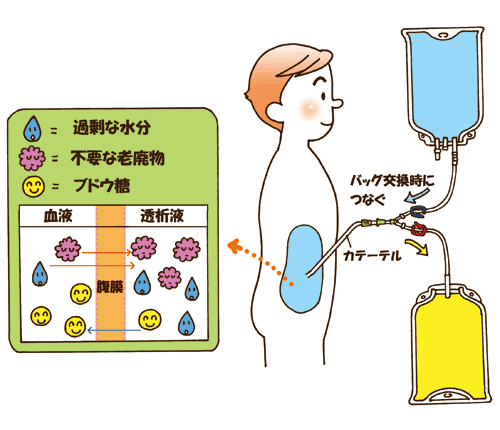 腹膜透析とは