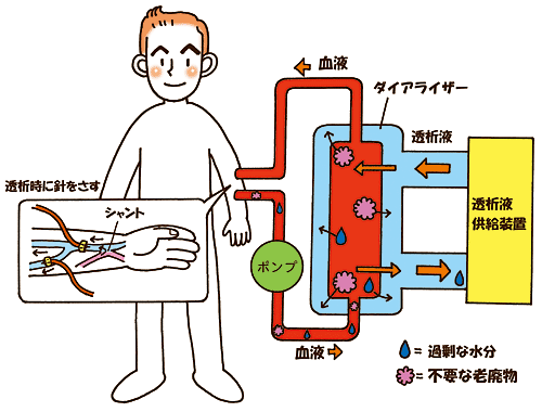 血液透析とは