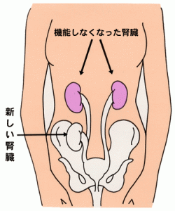 移植