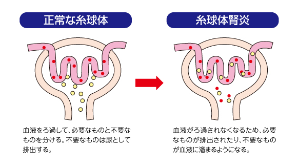 慢性糸球体腎炎